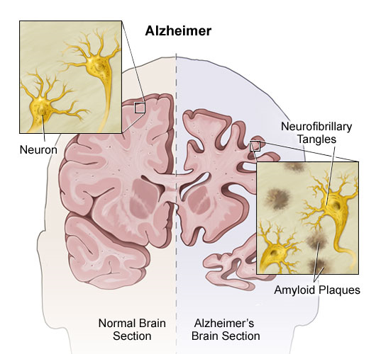 Alzheimer