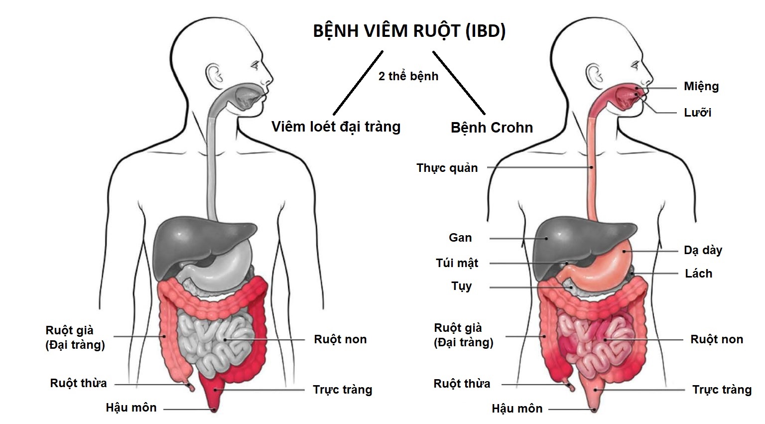 Bệnh viêm ruột