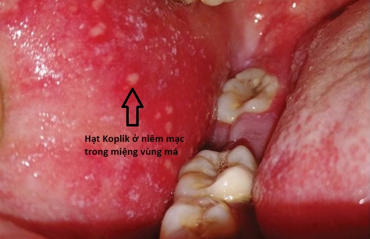 Hạt Koplik trong bệnh Sởi