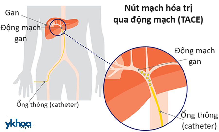 Nút mạch hóa trị qua động mạch (TACE)