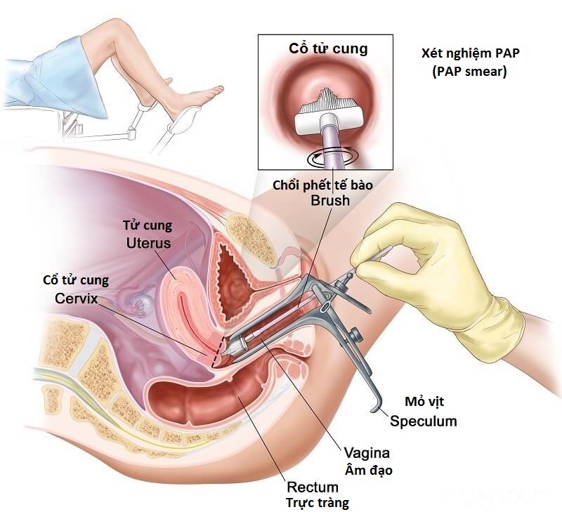 PAP smear (Xét nghiệm PAP)