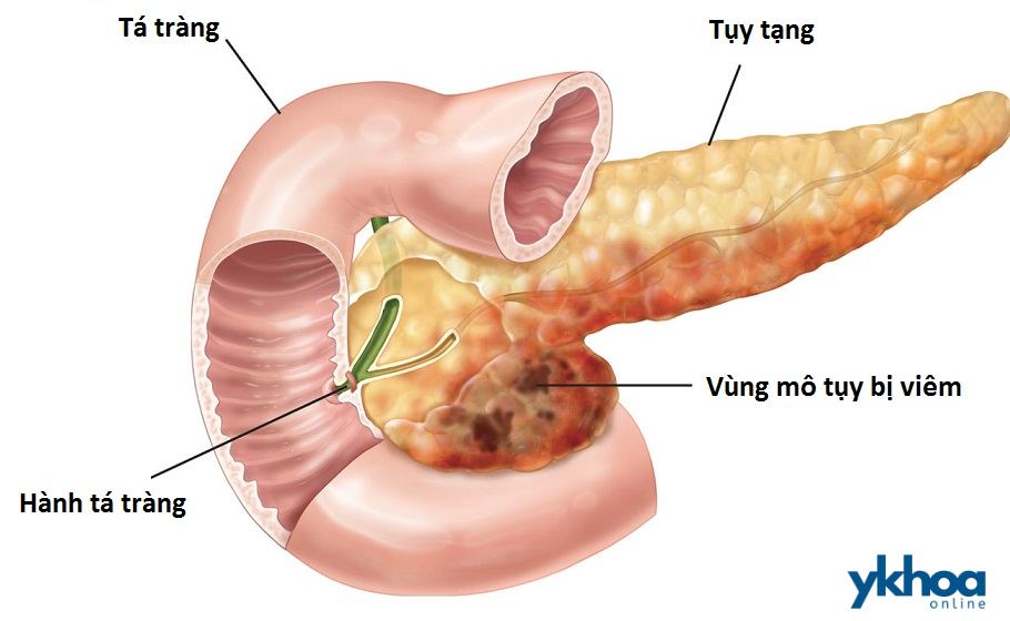 Viêm tụy cấp 