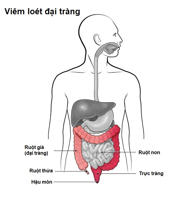 Viêm loét đại tràng