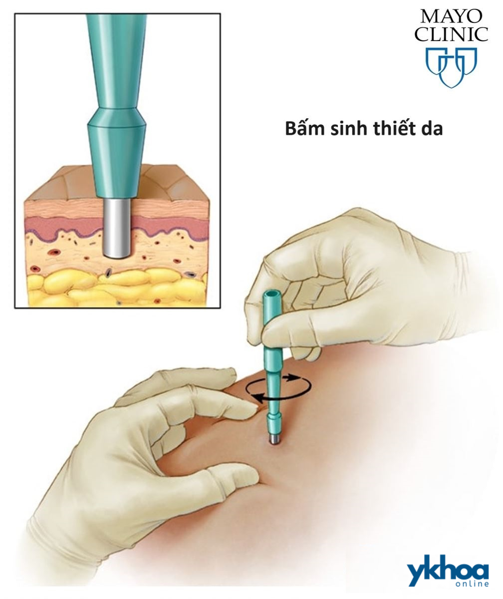 Bấm sinh thiết da