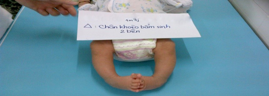 Bàn chân khoèo bẩm sinh và Bàn chân áp sinh lý 