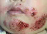 Herpes simplex