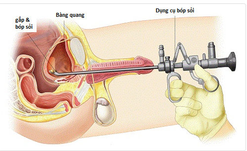 Bóp sỏi bàng quang qua nội soi