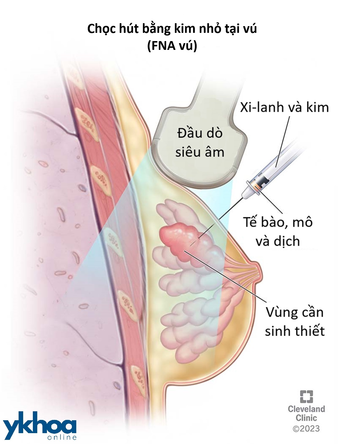 Chọc hút bằng kim nhỏ tại vú (FNA vú)