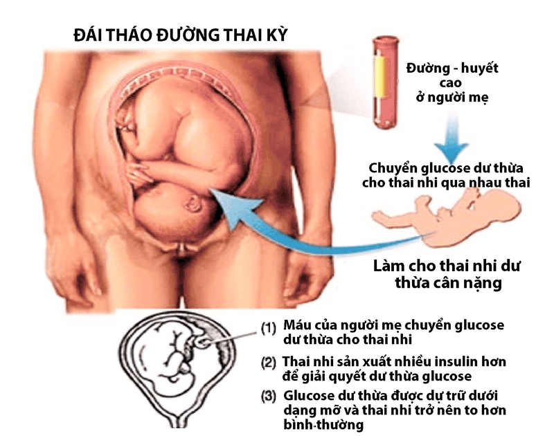 Đái Tháo Đường Thai Kỳ