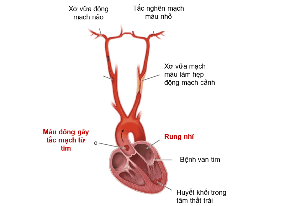 Đột quỵ do Rung nhĩ: cách ngăn ngừa hậu quả nặng nề