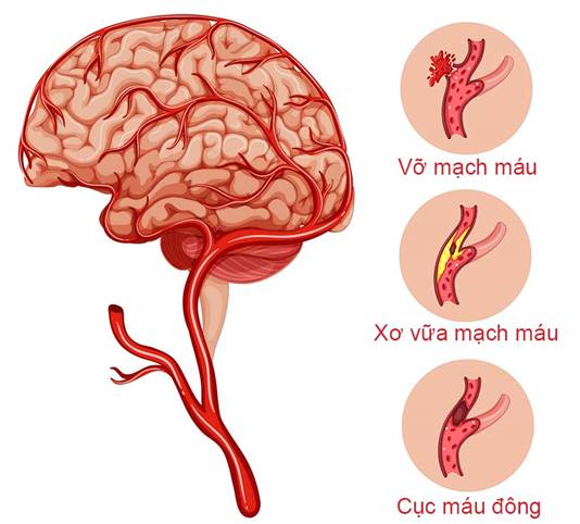 Đột quỵ & những dấu hiệu nhận biết 