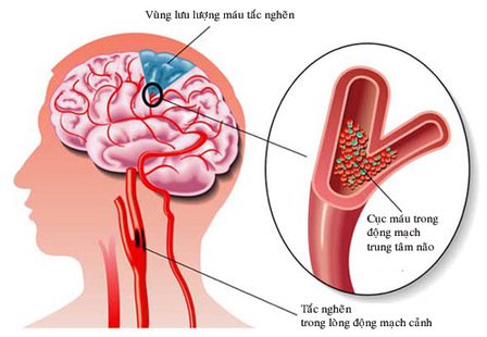 Đột quị