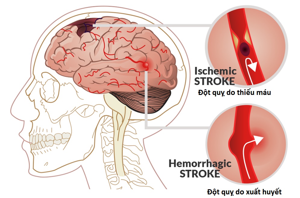 Đột quỵ do thiếu máu và đột quỵ do xuất huyết