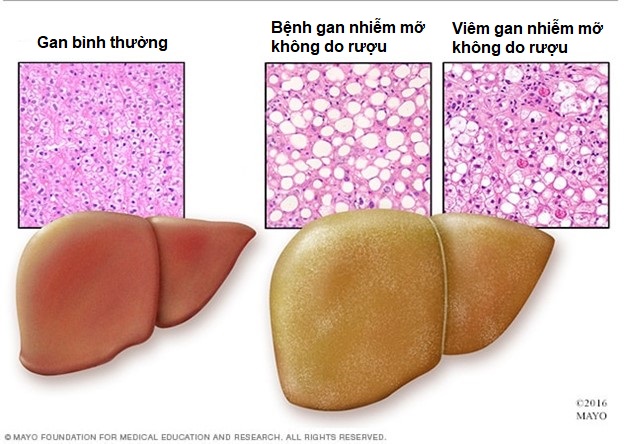 Gan nhiễm mỡ