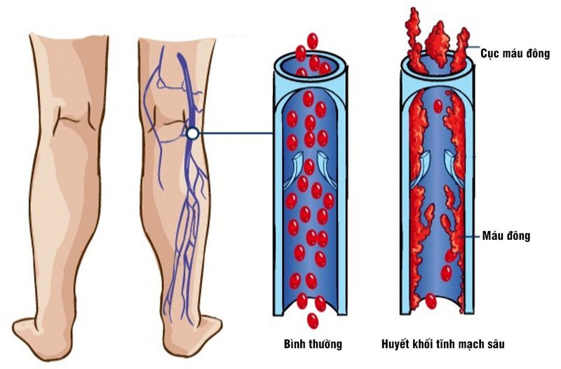 Huyết khối tĩnh mạch sâu: Cách phòng ngừa