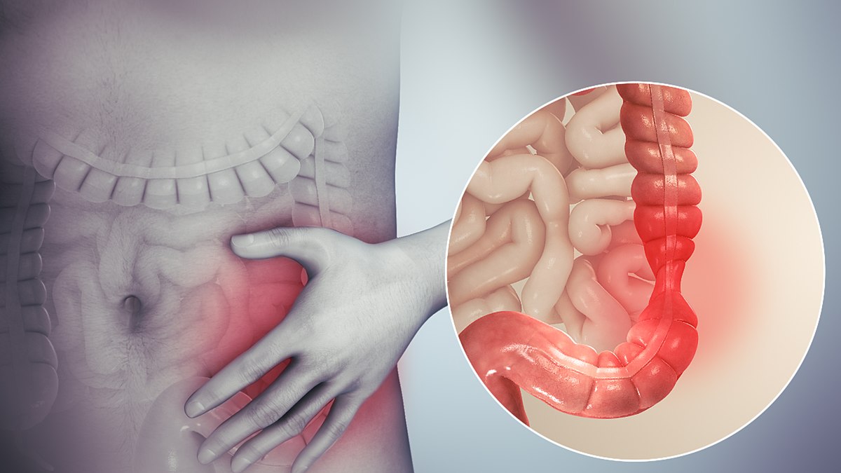 IBS (Hội chứng ruột kích thích)