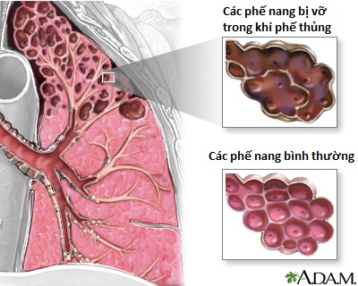 COPD