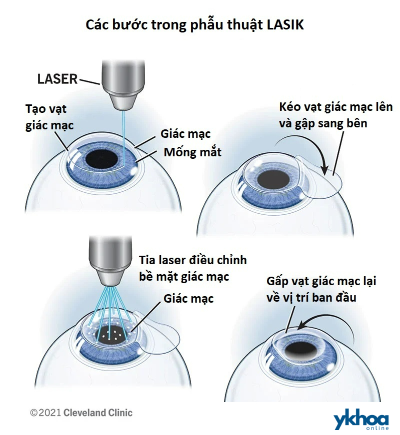 LASIK