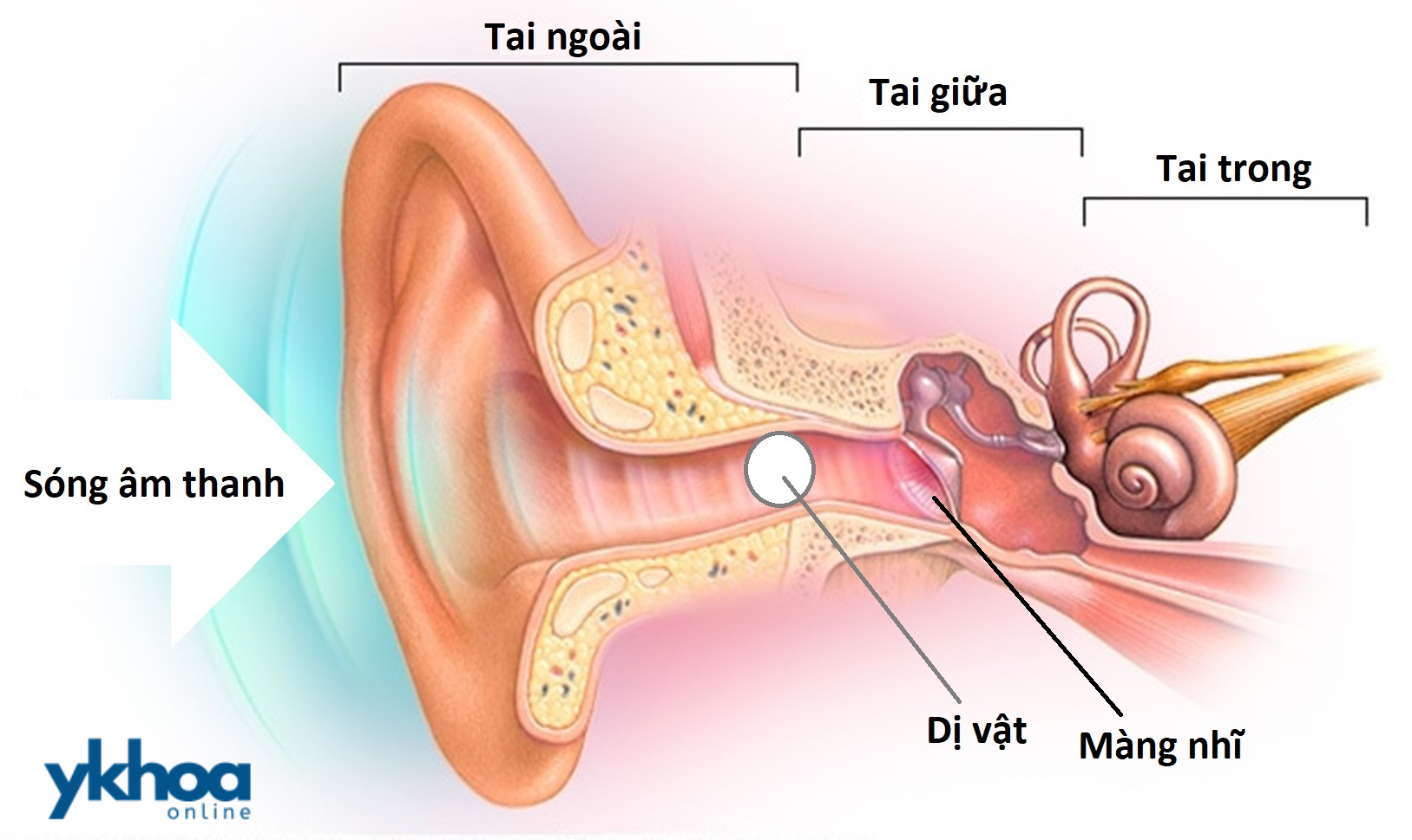 Lấy dị vật trong tai