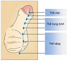 Lỗ tiểu thấp ở bé trai