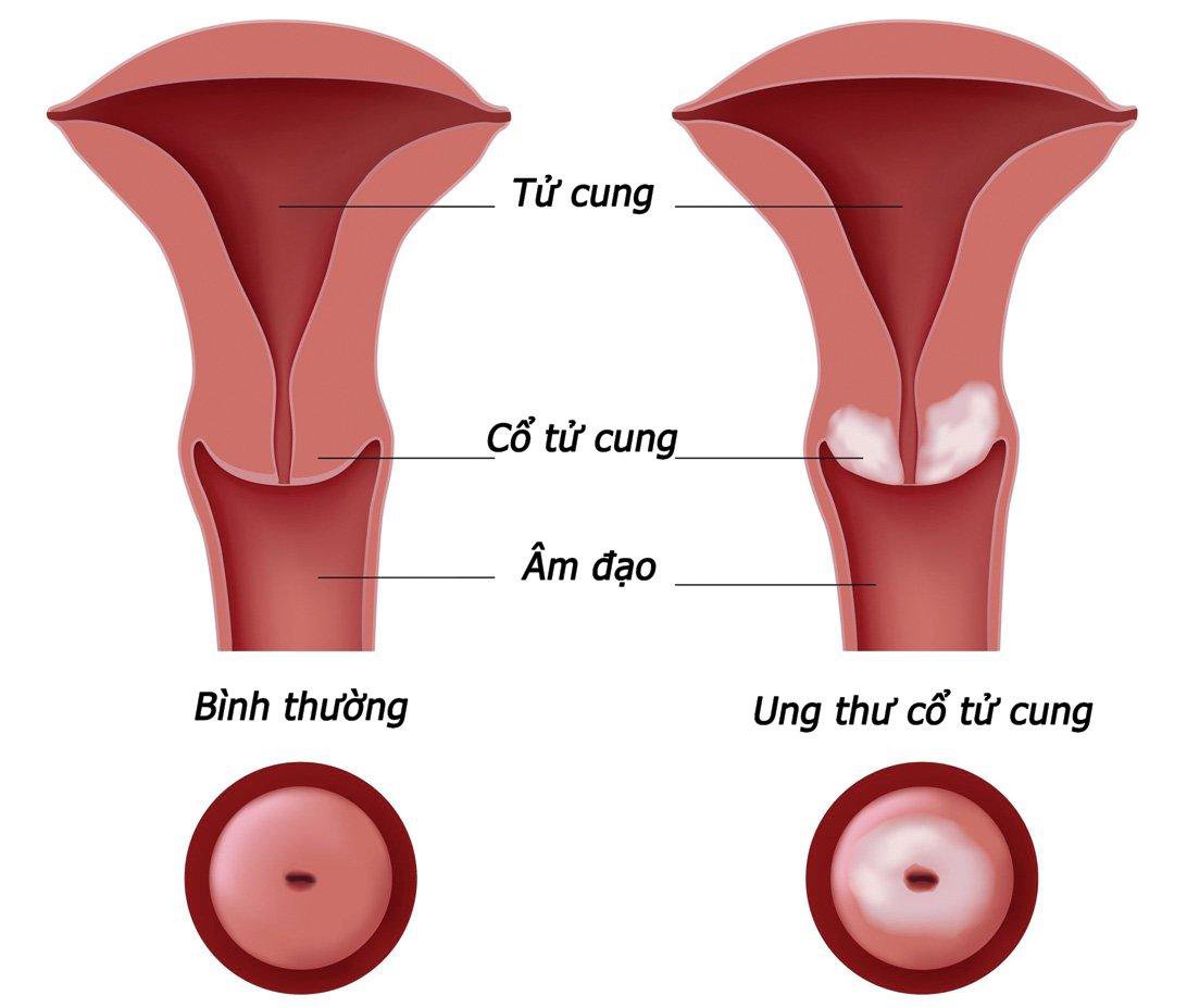 Những điều cần biết về vắc-xin HPV phòng ngừa ung thư cổ tử cung