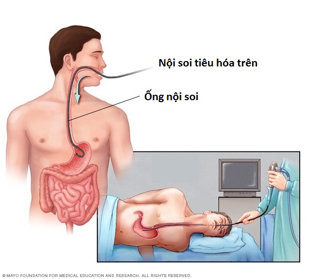 Nội soi tiêu hóa trên