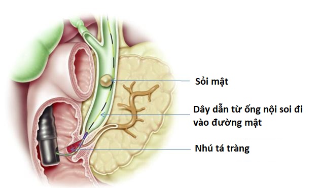 Nội soi mật tụy ngược dòng (ERCP)