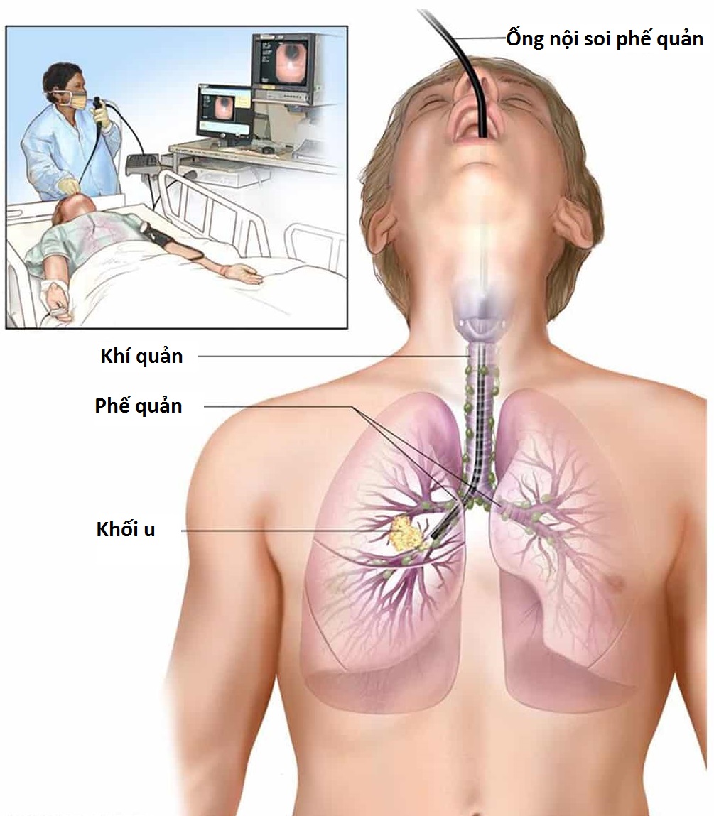 Nội soi phế quản