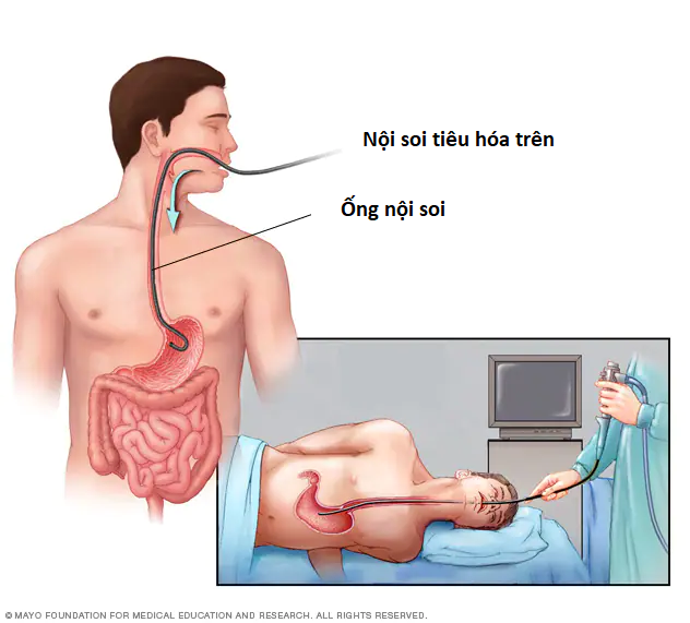 Xuất huyết tiêu hóa