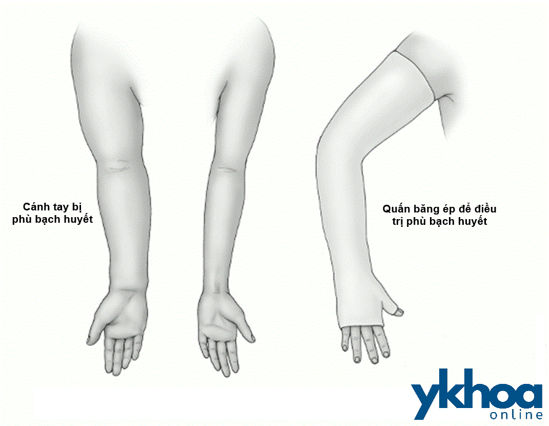 Phù bạch huyết ở cánh tay