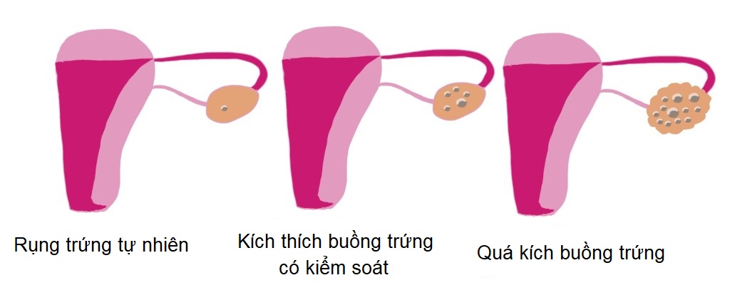 Quá kích buồng trứng