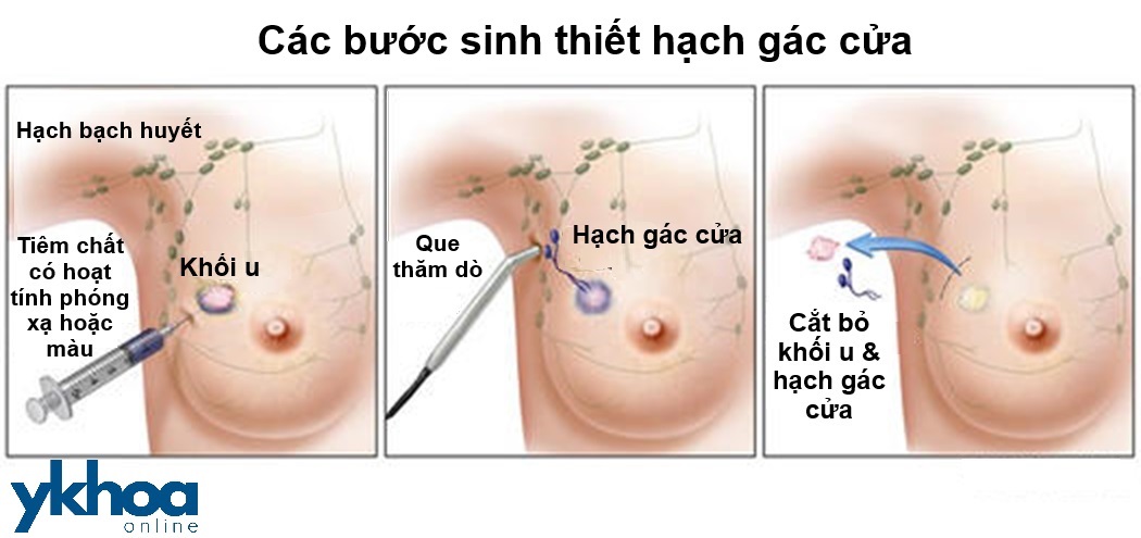 Các bước sinh thiết hạch gác cửa