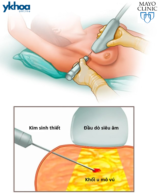 Sinh thiết kim lõi tuyến vú