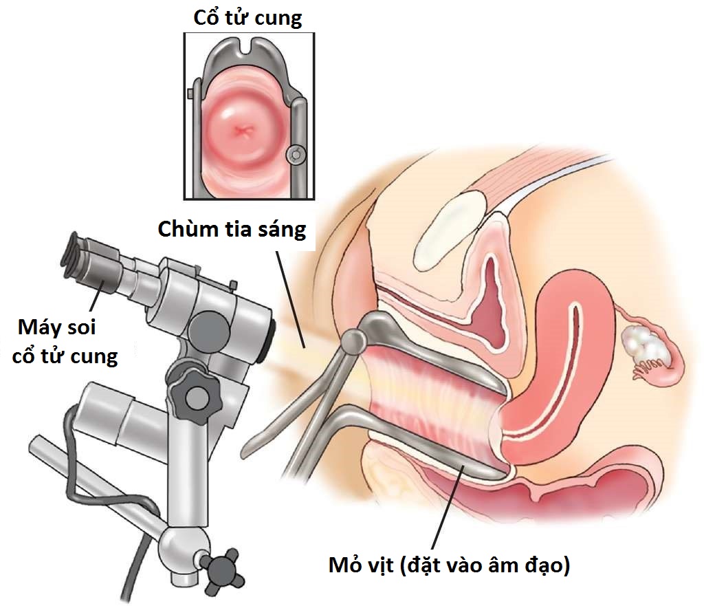 Soi cổ tử cung