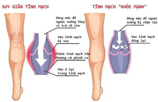 Suy tĩnh mạch