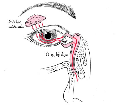 Tắc lệ đạo ở trẻ sơ sinh