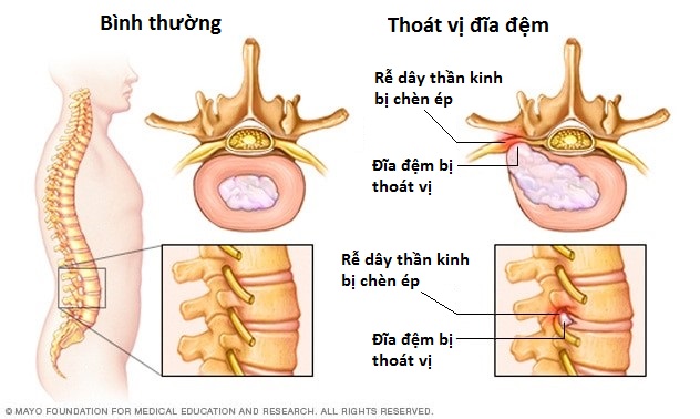 Thoát vị đĩa đệm