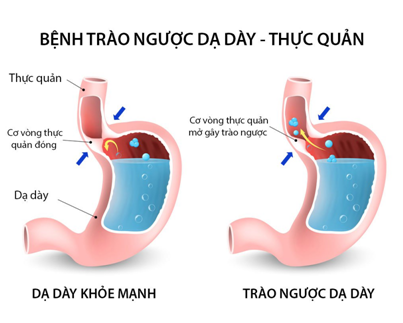 Trào ngược dạ dày thực quản ở trẻ sơ sinh