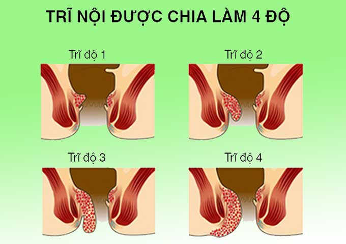 Phân độ trĩ nội