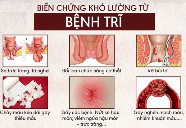 Biến chứng của bệnh trĩ