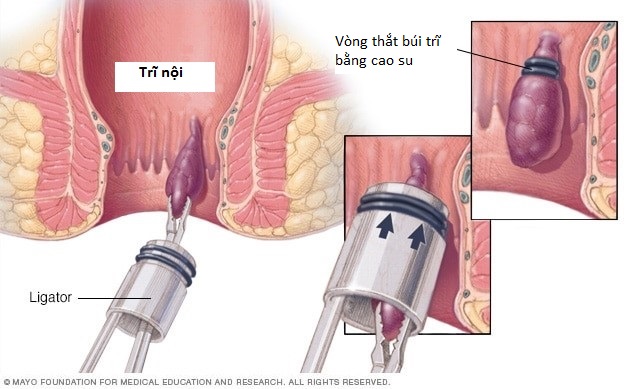 Cột búi trĩ