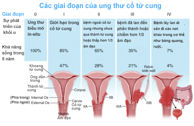 Các giai đoạn ung thư cổ tử cung