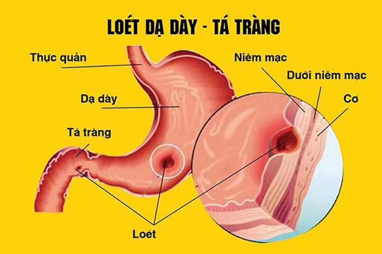 Viêm loét dạ dày - tá tràng