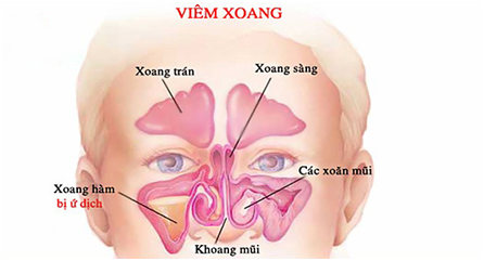 Viêm mũi xoang ở trẻ em