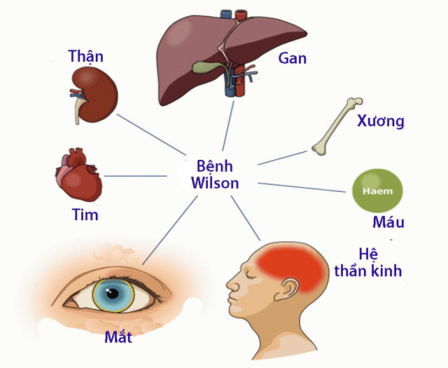 Wilson ở trẻ em