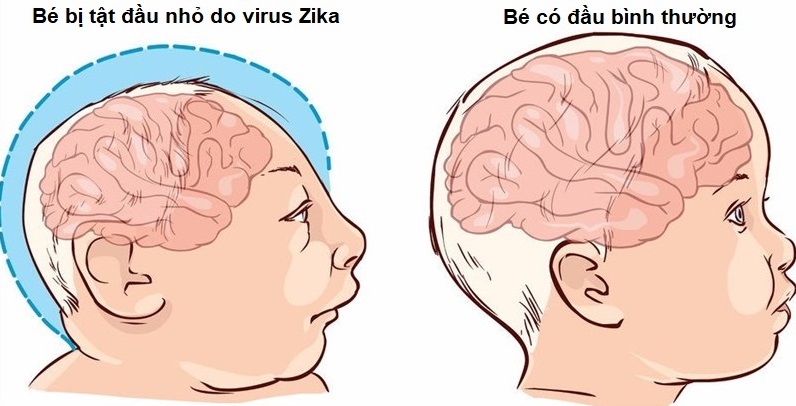 Virus Zika